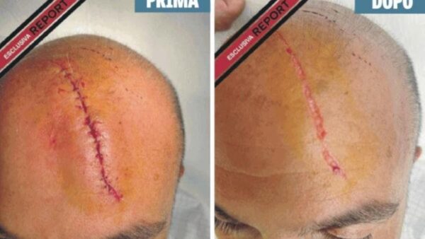 Caso Sangiuliano e violenza, ex marito riferisce di essere stato picchiato dalla stessa donna